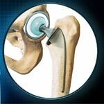 Am I a Candidate for Hip Replacement Surgery in Manchester?